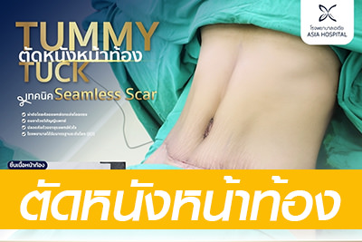 ผ่าตัดหนังหน้าท้อง-tummytuck